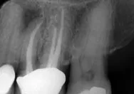 image of root canal treatment