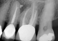 image of root canal treatment