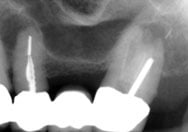 image of an apicoectomy that is close to the sinus