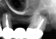 image of an apicoectomy that is close to the sinus