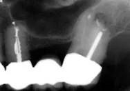 image of an apicoectomy that is close to the sinus