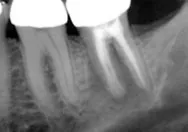 Re-treatment Canals