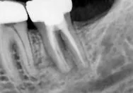 Re-treatment Canals