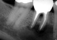 Apicoectomy image