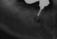 Retrograde Rct Mta Retrograde with MTA | Boston Endodontics