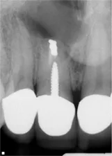 Apicoectomy image