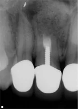 Apicoectomy image