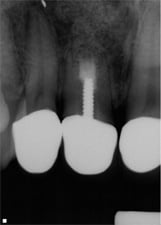 Apicoectomy image