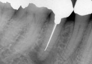 image of an apicoectomy
