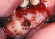Image of a apicoectomy