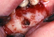 Image of a apicoectomy 