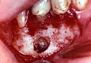 image of an apicoectomy