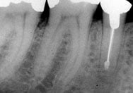 image of an apicoectomy